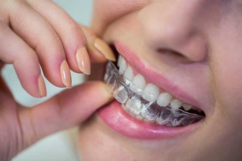 Invisalign at Omaha Family Dental: The Clear Path to a Beautiful Smile